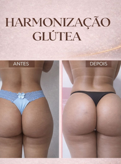 1.0 - Harmonização de Glúteos 1