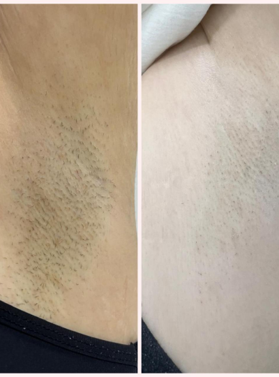 2.2 - Depilação a Laser nas Axilas 1