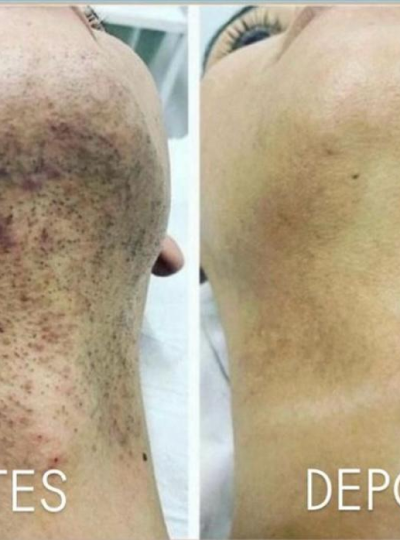 4.1 - Depilação a Laser na Barba 1