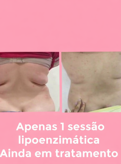 7.0 - Lipo Enzimática 1