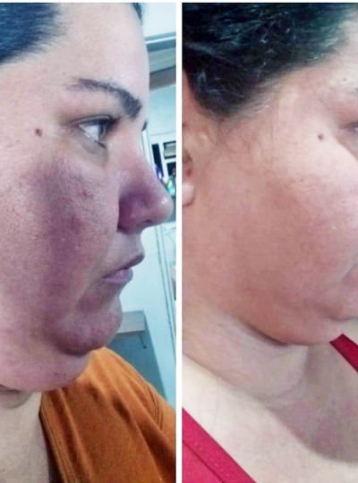 8.1 - Lipo de Papada (sem corte) 1