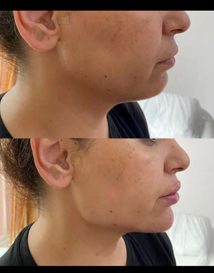 Harmonização Facial 3 1