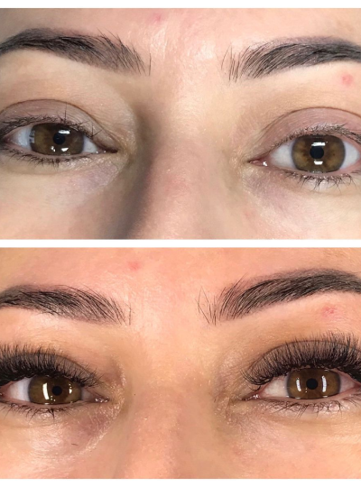 Harmonização Facial em Goiânia 1
